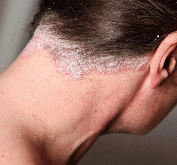 Come trattare la psoriasi