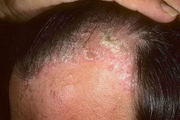 Sintomi di psoriasi