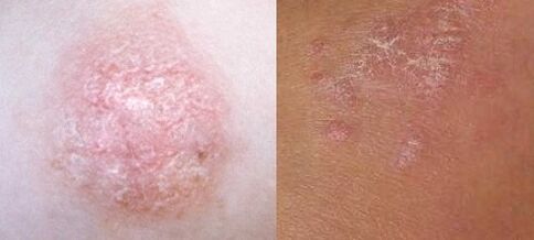 Psoriasi nelle prime fasi